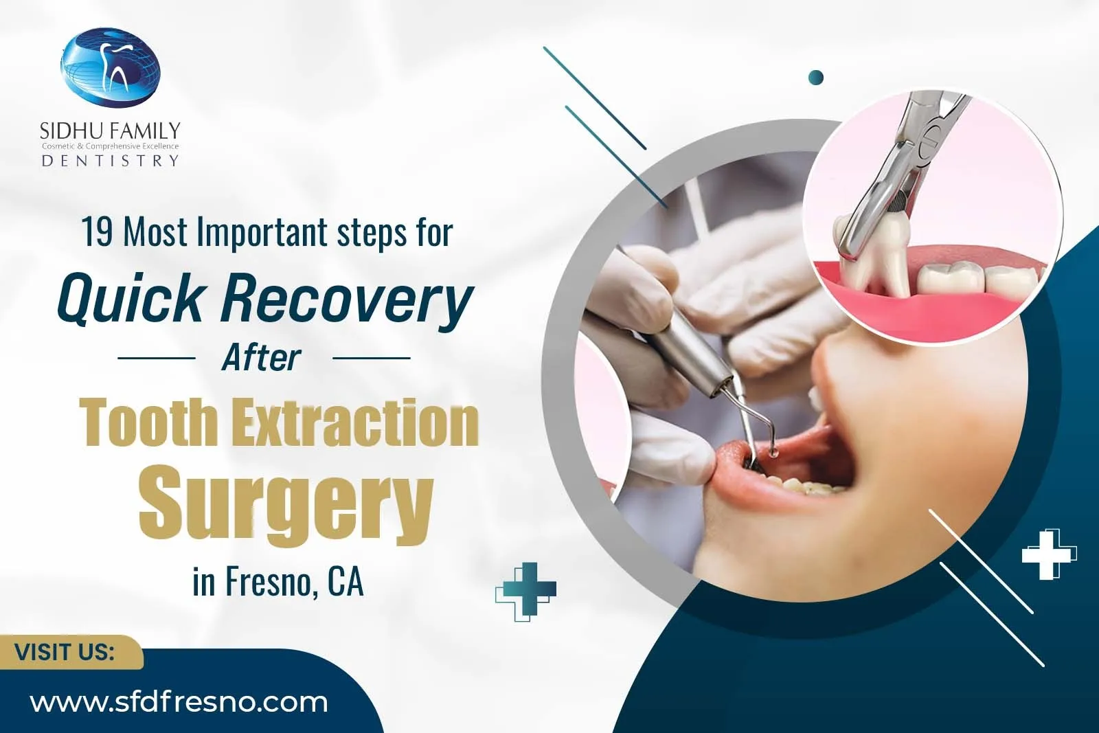 Tooth Extraction Surgery in Fresno CA
