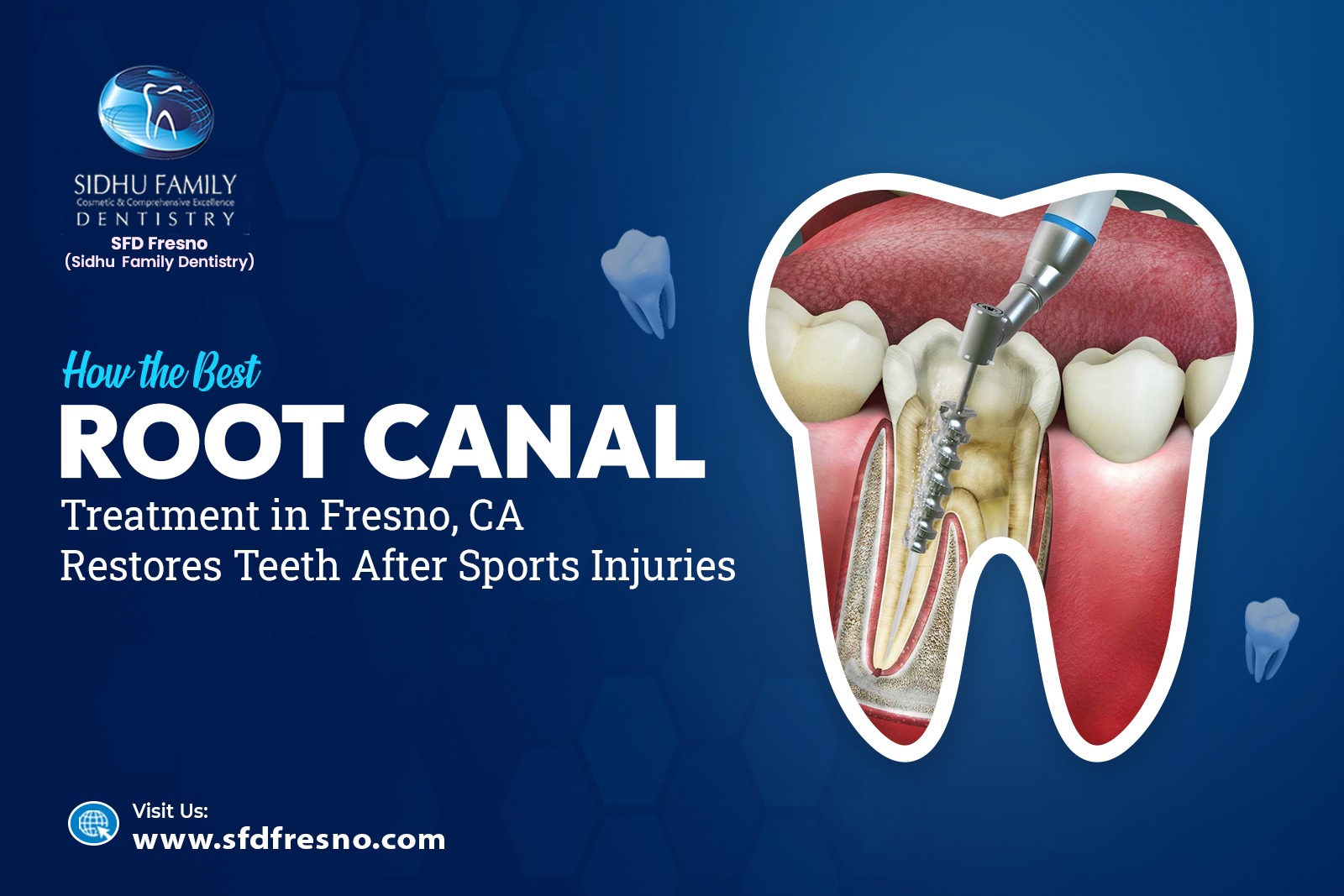 Best Root Canal Treatment in Fresno, CA