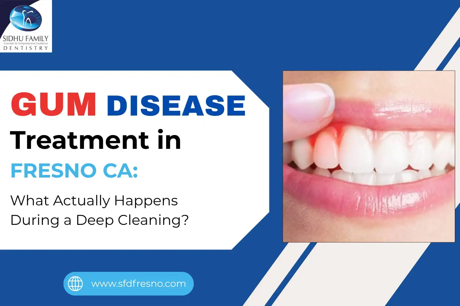 Gum Disease Treatment in Fresno, CA